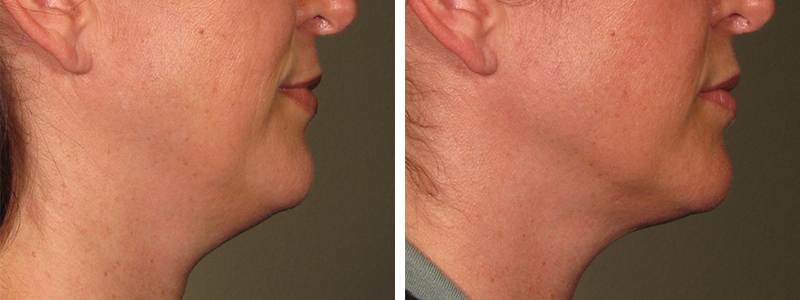 Ultherapy before after patient 1.