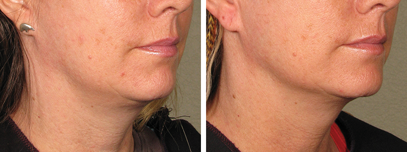 Ultherapy before after 2.